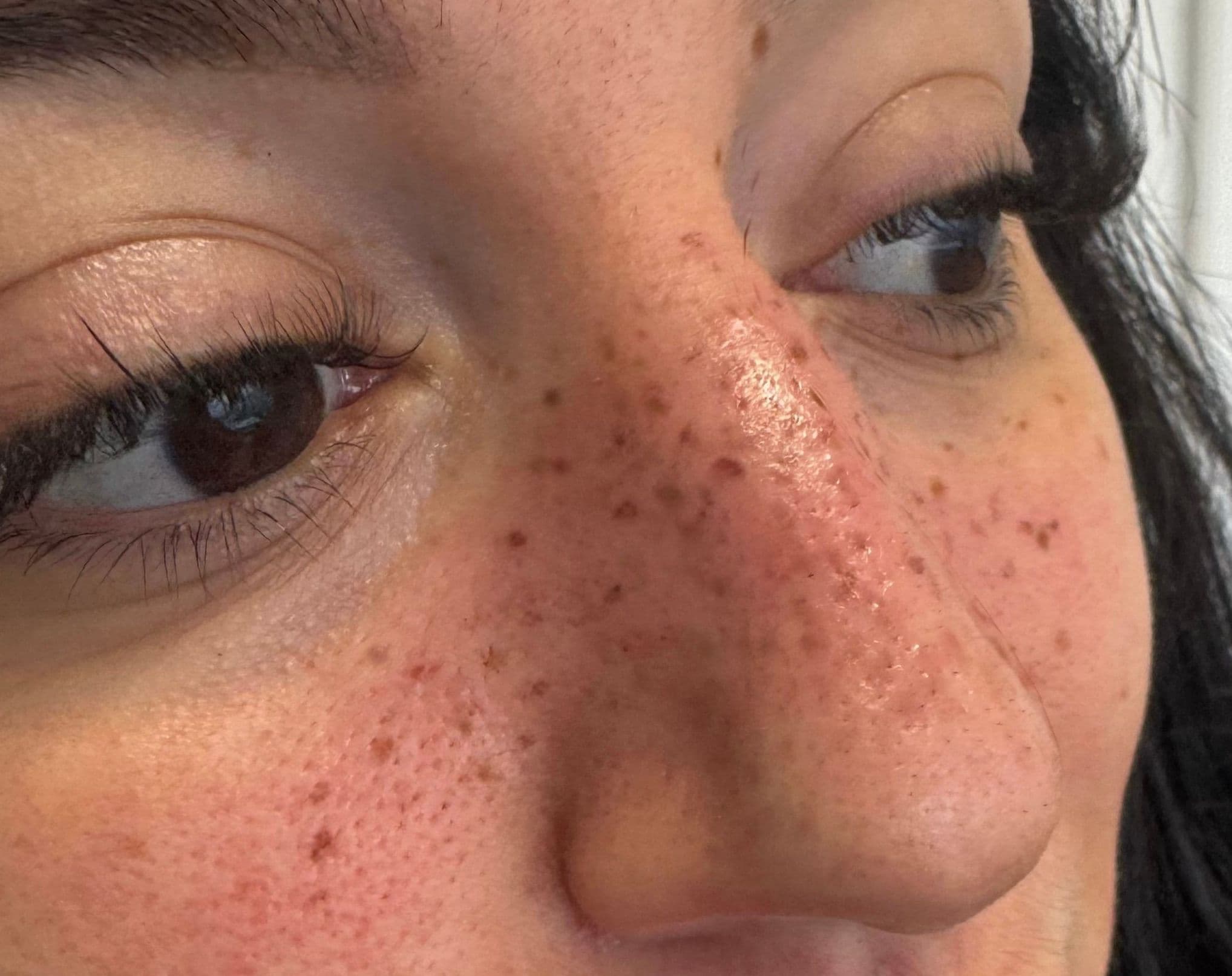 Pigmentation permanente de taches de rousseur sur peau mate, résultat intense et défini sur le nez et les joues, expertise Habiba Med.